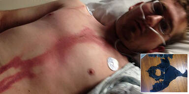 Mann (34) von Blitz gezeichnet