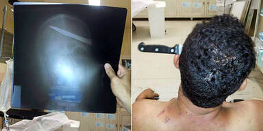 Brasilianer mit Messer im Kopf