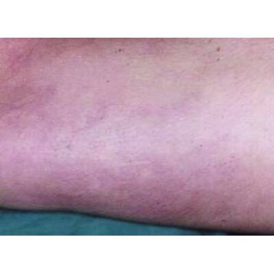 Couperose nach der Laserbehandlung