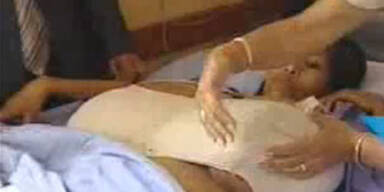 Peruanerin hat 12 Kilo schwere Brüste