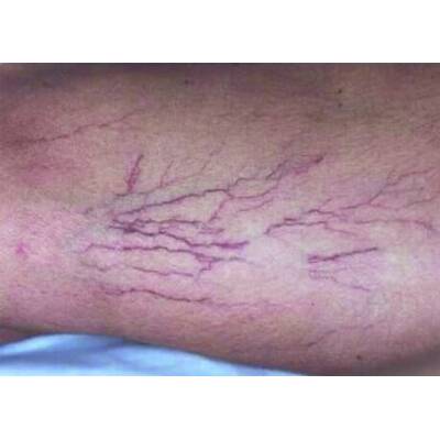 Couperose nach der Laserbehandlung