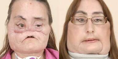 46-Jährige bekam neues Gesicht