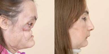 46-Jährige bekam neues Gesicht