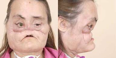 46-Jährige bekam neues Gesicht