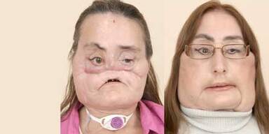 46-Jährige bekam neues Gesicht