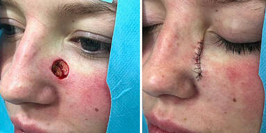 Frau bekommt nach Solarium-G&auml;ngen Loch im Gesicht