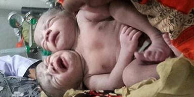 M&auml;dchen mit zwei K&ouml;pfen geboren