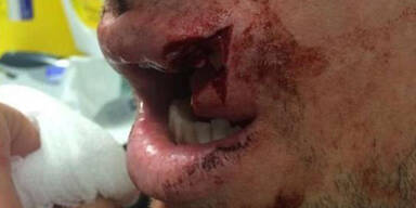 Rugby-Spieler verletzt sich