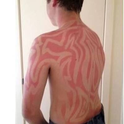 Sonnenbrand-Tattoo
