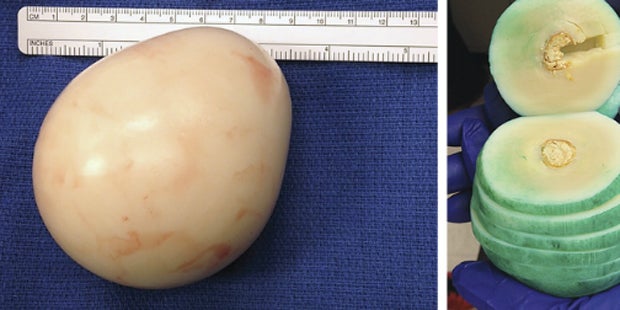 Mann wuchs Riesen-Ei aus Gummi im Bauch