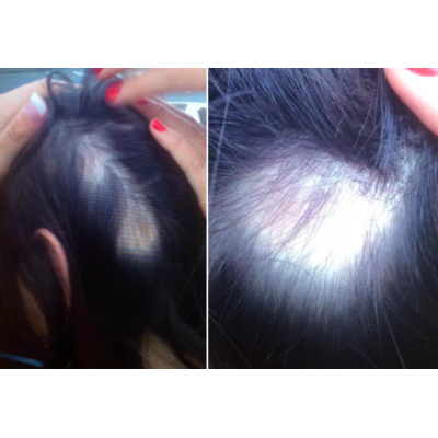 Promi-Shampoo verursacht Haarausfall