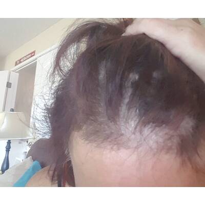 Promi-Shampoo verursacht Haarausfall