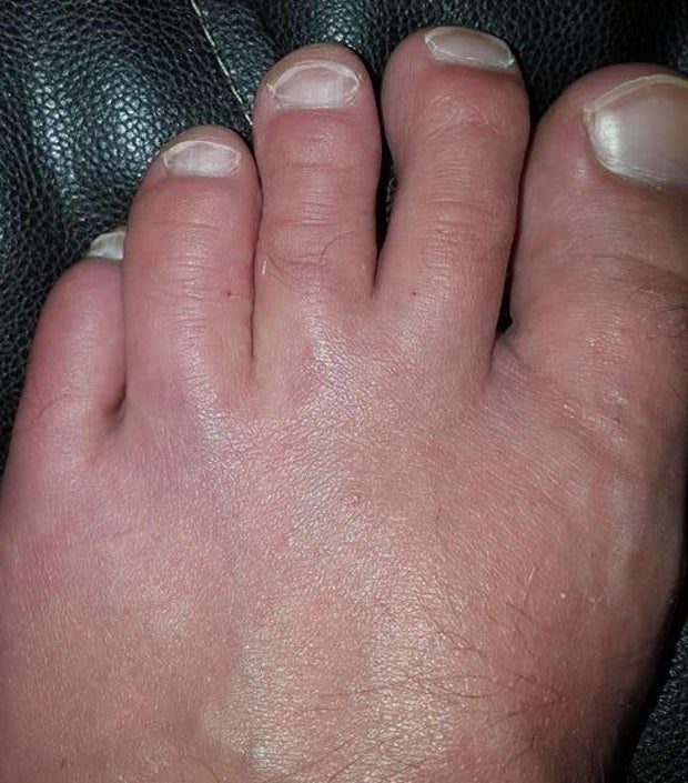 Fleischfressender Wurm befällt Pärchen