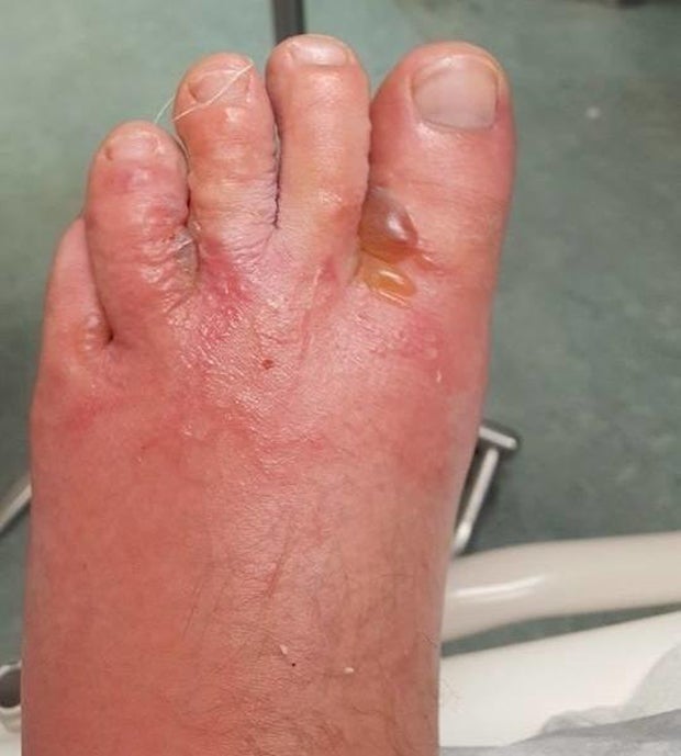 Fleischfressender Wurm befällt Pärchen