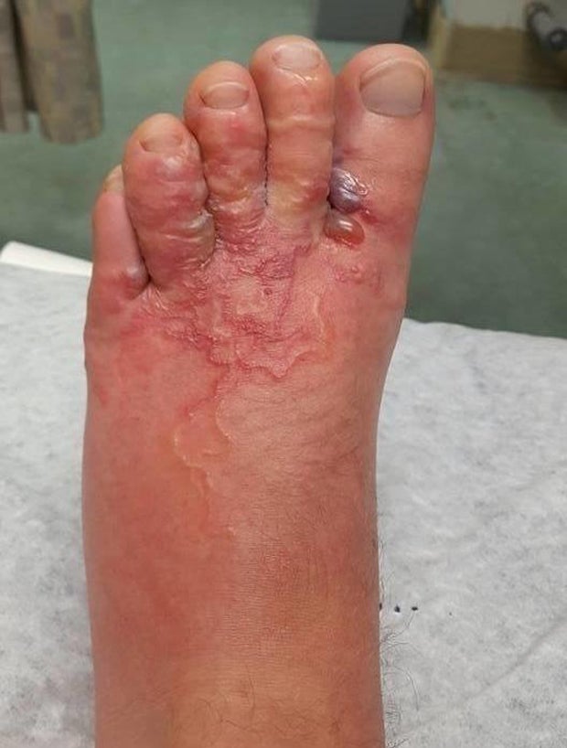 Fleischfressender Wurm befällt Pärchen