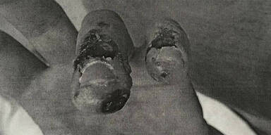 Fieser S&auml;ure-Angriff auf Wiener Sanit&auml;ter