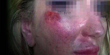 Frau brutal verpr&uuml;gelt