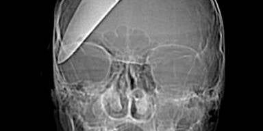 Diebe rammten Teenager Messer in den Kopf