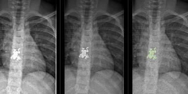 Mädchen hatte Frosch im Hals