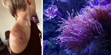 Bub (7) von Seeanemone gestochen