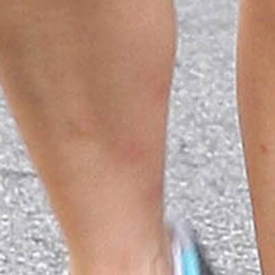 Kim Kardashian: Kampf gegen Hautkrankheit