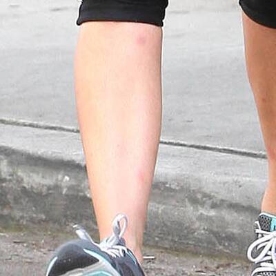 Kim Kardashian: Kampf gegen Hautkrankheit