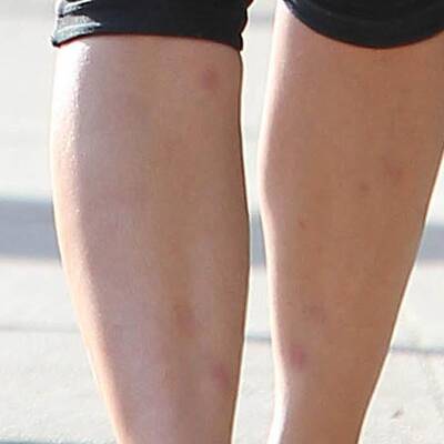 Kim Kardashian: Kampf gegen Hautkrankheit