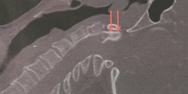 Frau kann nach Genickbruch wieder gehen