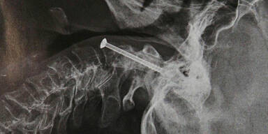 Frau kann nach Genickbruch wieder gehen