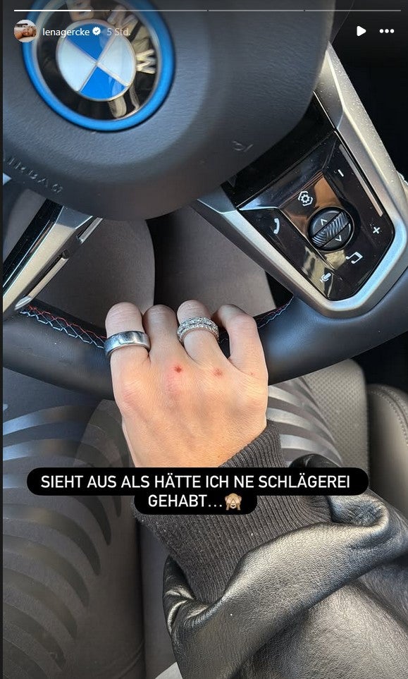 Lena Gercke hat sich die Fingerknöchel verletzt. 