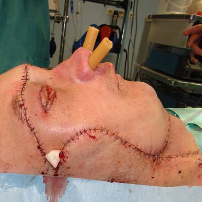 Gesichtstransplantation in Polen