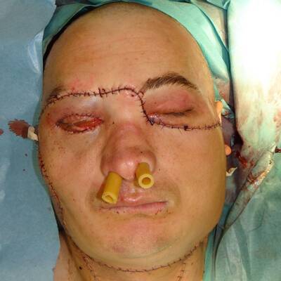 Gesichtstransplantation in Polen