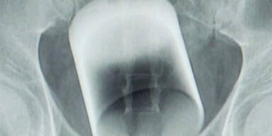 Not-OP: Mann hatte Trinkglas im Hintern