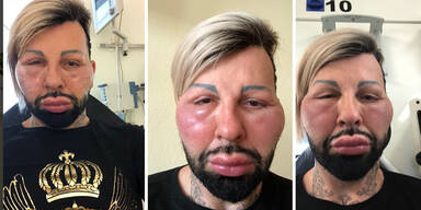 Harald Gl&ouml;&ouml;ckler Allergie