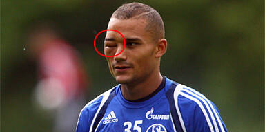 Schalke-Goalie ins Aug gestochen