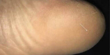 Mann leidet H&ouml;llen-Qualen wegen Haar im Fu&szlig;