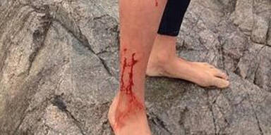 13-J&auml;hriger nimmt Hai-Attacke gelassen