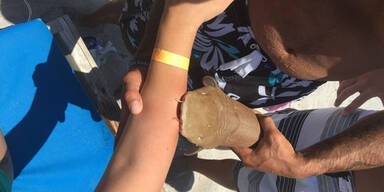 Frau kam mit Hai am Arm ins Krankenhaus