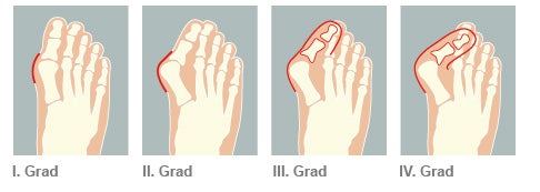 Hallux Valgus: Wie man vorbeugen kann