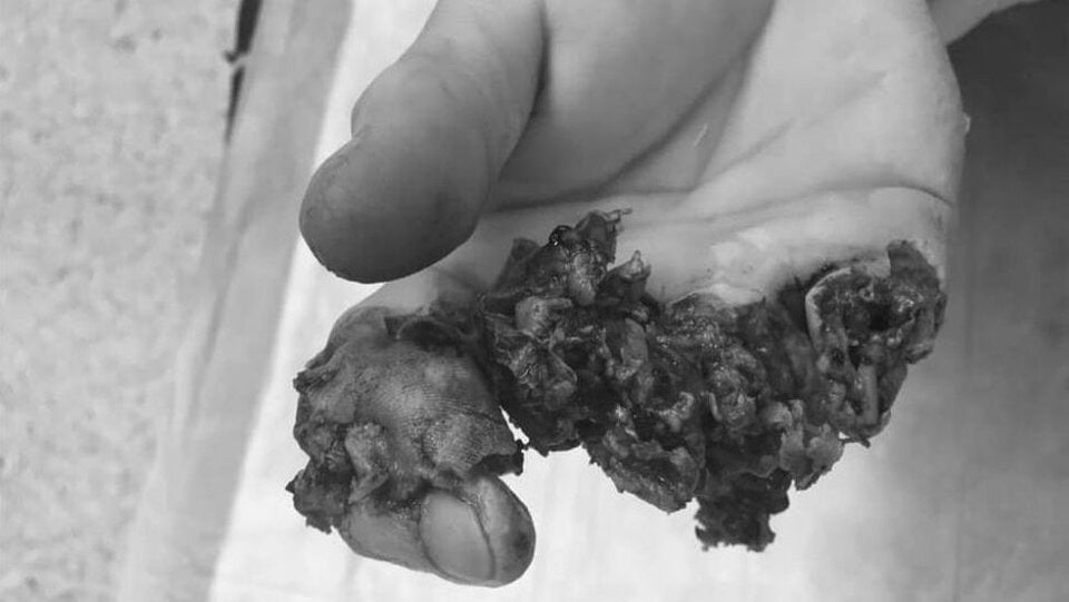 Klinik warnt mit Schock-Foto vor Böllern