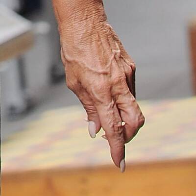 Kirstie Alley: Glattes Gesicht, faltige Hände