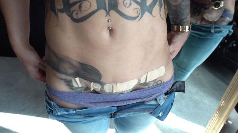 Influencerin lässt sich Nazi-Tattoo rausschneiden