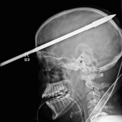 Harpune im Kopf überlebt