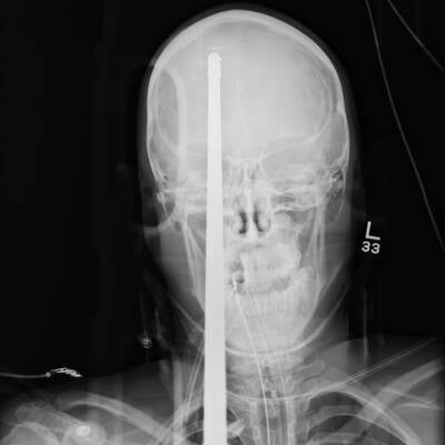 Harpune im Kopf überlebt