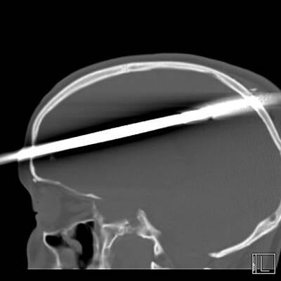 Harpune im Kopf überlebt