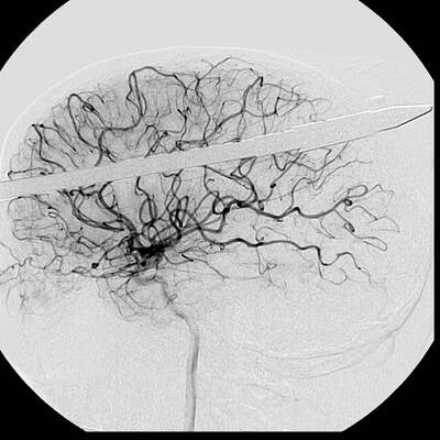 Harpune im Kopf überlebt