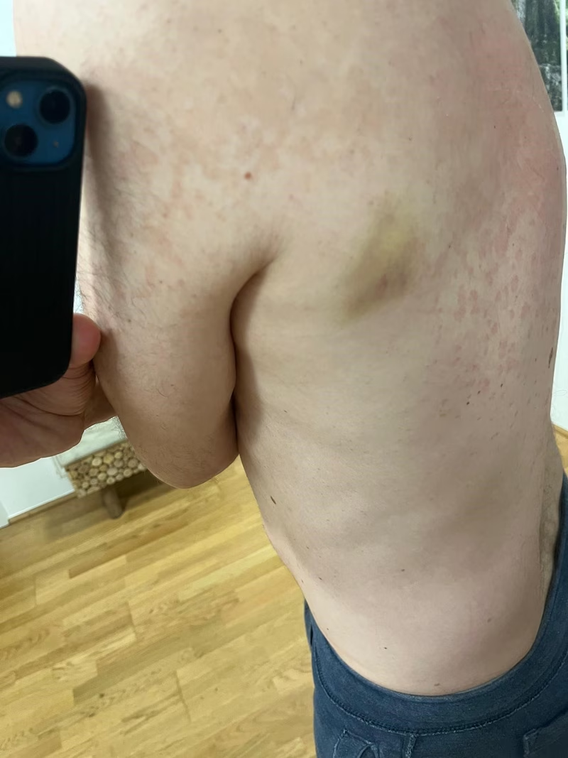 Gudenus dokumentierte seine blaue Flecken nach der Rangelei