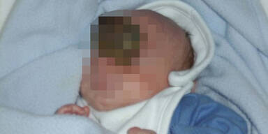 Baby mit Hirn am Gesicht geboren