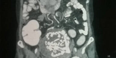 Frau trug Baby 36 Jahre lang im Körper 