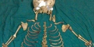 Frau trug Baby 36 Jahre lang im Körper 